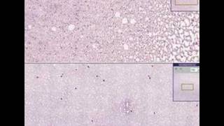 Histopathology BloodChronic lymphocytic leukemia [upl. by Garibull]