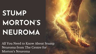 Detailed account of the diagnosis and treatment of Stump Mortons Neuroma [upl. by Trammel]