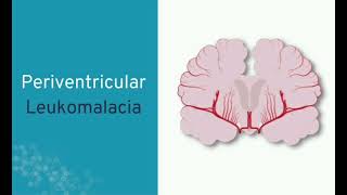 PVL Periventricular leukomalacia mrcpch Communication [upl. by Rois784]