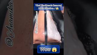 😱How To Remove Blackheads At HomeBlackhead removal 1 shorts skincare youtubeshorts Anamika Barai [upl. by Alimak]