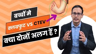 Clubfoot3 सीटीईवी vs क्लबफुट क्या दोनों अलगअलग हैं CTEV vs Clubfoot kya ye dono alag hain [upl. by Debby]