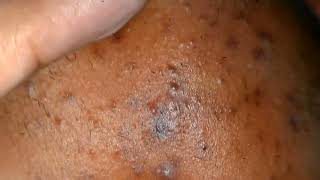 sac be spa blackheads elderly 2024  sac be spa old age blackheads 2024  sac be spa thuy video 300 [upl. by Silbahc965]