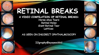 Retinal breaks as seen on indirect ophthalmoscopy  a video compilation [upl. by Hgielac]