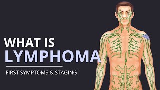 What is Lymphoma First SYMPTOMS and How Its STAGED  The Patient Story [upl. by Solrak766]