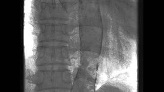 Dense Calcification in the Aorta [upl. by Safir]