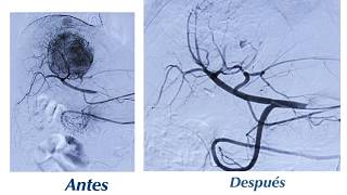 Arteriografía hepática para el tratamiento de una lesión tumoral  Sabbag Radiólogos [upl. by Nealon149]