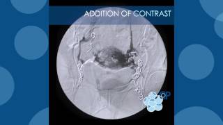 Pelvic Vein Embolisation  Live procedures at the 2nd International Veins Meeting [upl. by Hsara]