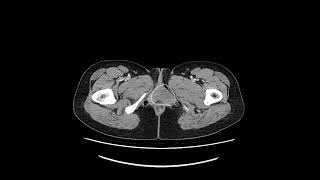 Bartholin gland cyst [upl. by Wilkie430]