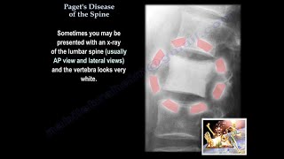 Pagets Disease Of The Spine  Everything You Need To Know  Dr Nabil Ebraheim [upl. by Ronica]