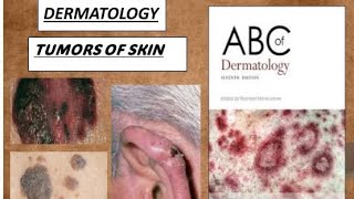 DERMATOLOGY TUMORS OF EPIDERMIS DERMIS amp MELANOCYTES PART1 benign amp malignant derma tumors [upl. by Merilee505]