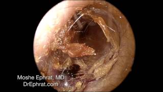 Ear Wax Removal [upl. by Eido]