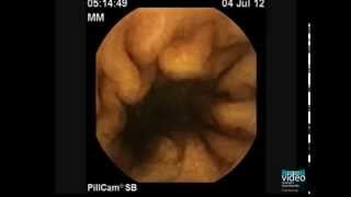 The PillCam Detection of Meckels Diverticulum [upl. by Htenek63]