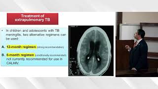 Childhood TB  Adulthood TB  HIV  extra pulmonary TB  liver disease  DM PART 2 [upl. by Emilee536]