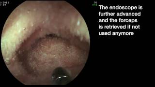 How to access a difficult ileocecal valve with a biopsy forceps [upl. by Silma]