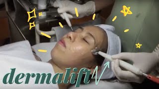 Dermalift Treatment [upl. by Ahsyekat]