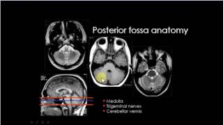 posterior cranial fossa anatomy in MRICT [upl. by Hanid]