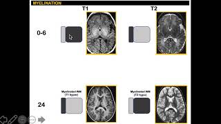 Myelination in MRI 14 simplified [upl. by Mccandless126]