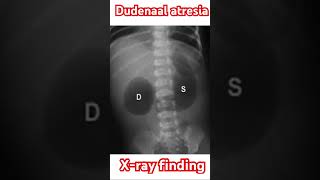 DOUBLE BUBBLE SIGN Dudenaal atresia patients xray finding NURSINGSUCCESS [upl. by Nauhs]