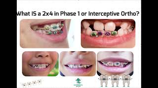 What is a 2x4 in Interceptive Ortho Phase 1 Braces Explained [upl. by Marquez827]