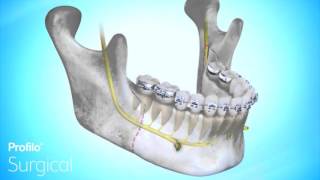 BSSO  Lower Jaw Advancement Surgery [upl. by Jordison]