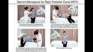 Semont Manoeuvre for Right Posterior Canal BPPV [upl. by Grimbal]