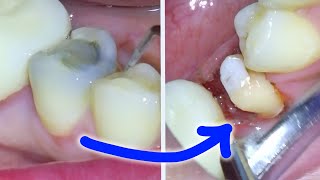 Full Dental Crown Procedure After a Root Canal On a Molar Permanent amp Temporary Tooth Cap Guide [upl. by Ahsenav]