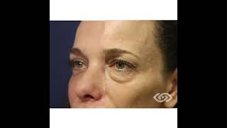 Blefaroplastia Superior e Inferior con Laser Antes y despues Short [upl. by Consalve]