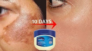 Vaseline To Remove Skin Pigmentation amp Dark Spots In Just 10 Days  100 Effective Home Remedy [upl. by Calore]