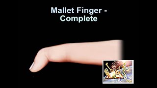 Mallet Finger Complete  Everything You Need To Know  Dr Nabil Ebraheim [upl. by Iew480]