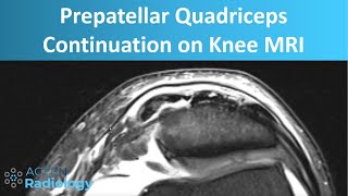 Prepatellar Quadriceps Continuation on Knee MRI  Anatomy and Pathology [upl. by Genny]