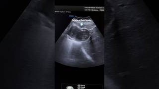 Hepatic Hydatid Cyst Ultrasound  Liver Sonography ardms radiology abdomen cyst sonographer [upl. by Jolynn]