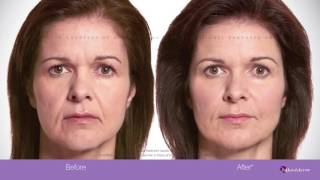 Allergan Botox [upl. by Mcgean]