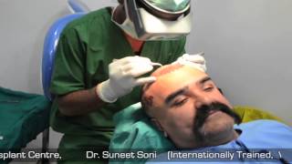 Cost Effective Hair Transplant in India Jaipur Delhi at Medispa by Dr Suneet Soni [upl. by Elna]