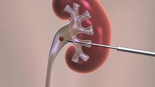 Percutaneous Nephrolithotomy [upl. by Kenta]