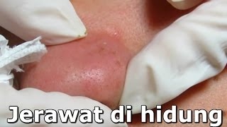 Jerawat di hidung  Bagaimana tekan jerawat dengan benar AAHC [upl. by Emogene]