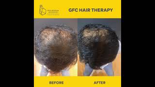 GFC and PRP for hair loss growthfactorconcentrate plateletrichplasma gfctherapy shorts [upl. by Ibrik78]