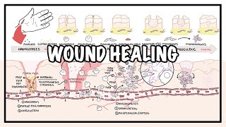 Wound Healing  Stages of healing and pathology [upl. by Ecinaj]