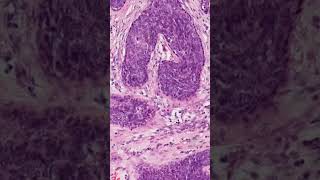 Nipple Adenoma Histology  Pathology shorts [upl. by Elum]