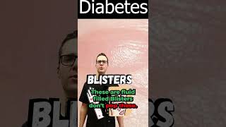 Blister on Foot Toe or Between Toes Diabetic Skin Symptoms [upl. by Runkel]