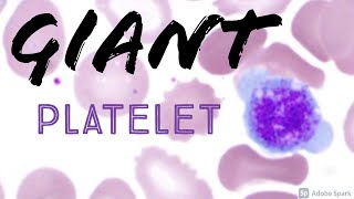 Giant Platelet on Peripheral Blood Smear Hemepath Hematology Pathology [upl. by Malha637]