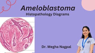 Ameloblastoma  Histopathology  Easiest Diagrams  Oral Pathology BDS [upl. by Walker]