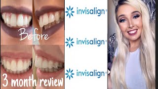 Invisalign Overbite Correction  3 Month Review With Before amp After Pics [upl. by Ayatan71]