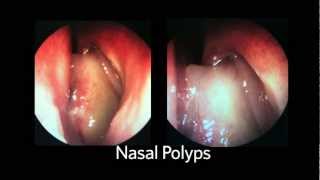 AAOHNSF The ENT Exam Episode 4 The Nasopharynx and Larynx Exam [upl. by Adnovoj]