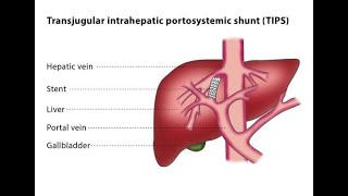 Transjugular Intrahepatic portosystemic Shunt  Procedure indications benefits Uses [upl. by Nnaeel]