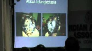 Ataxia telangiectasia  DrJBhaskar  Part 1 of 2 [upl. by Afital]