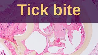 Tick Bites  Pathology mini tutorial [upl. by Kazim566]