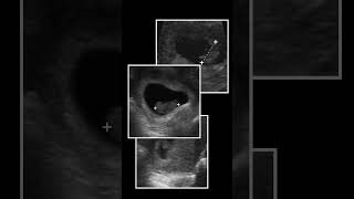 Ultrasound Progression of the 1st Trimester pocus ultrasound [upl. by Giesecke]