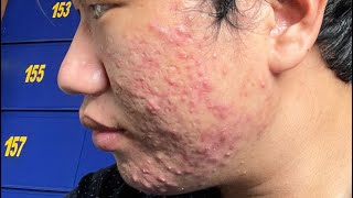 5 months before and after Isotretinoinaccutane transformations  Very Severe Acne Scars Journey [upl. by Duke]