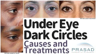 What Causes Under Eye Dark Circles and How they are Treated [upl. by Hcnarb]