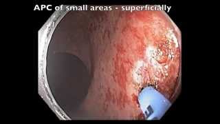 Rectum  Radiation Telangectasia in Prostate Cancer after Radiation [upl. by Webb]